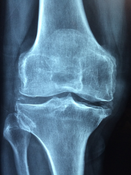 Joint pain issues
