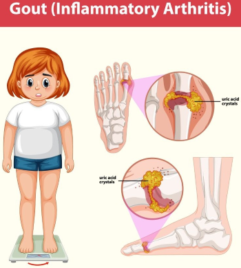 Gout (Inflammatory Arthritis)